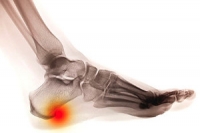 Types of Heel Spurs