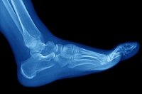 How do Stress Fractures Happen?