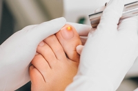 Key Facts About Laser Treatment for Fungal Nails