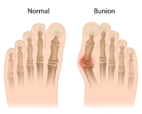 Various Types of Bunions and Different Treatments