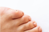 Risk Factors for Developing Foot Corns
