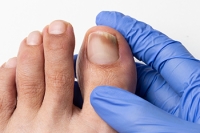 Managing Stubborn Toenail Fungus