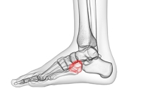 Lateral Foot Pain and Cuboid Syndrome