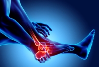 Managing Foot Arthritis