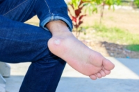 What You Need to Know About Plantar Warts